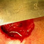 日本科学家发现新化合物可抑制皮肤癌